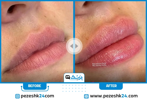 قبل و بعد تزریق ژل لب دکتر امین عسکریان