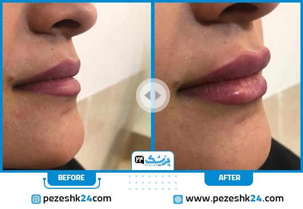 قبل و بعد ژل لب دکتر بهداد شیراز
