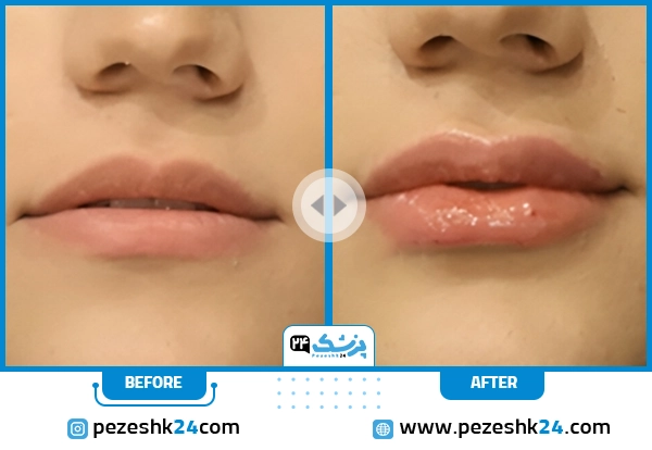 قبل و بعد تزریق ژل لب دکتر بهداد شیراز