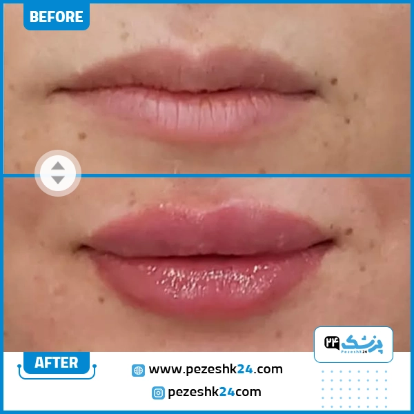 قبل و بعد ژل لب دکتر ماندانا ابراهیمی