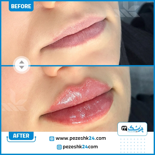 قبل و بعد تزریق ژل لب دکتر خسروی شیراز