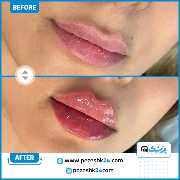 نمونه تزریق ژل لب دکتر خسروی شیراز