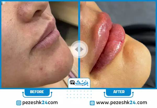 نمونه کار قبل و بعد بهترین کلینیک تزریق ژل لب در اصفهان کلینیک سینایار