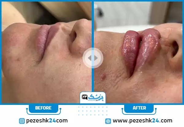 عکس قبل و بعد تزریق ژل لب در کلینیک سینایار در اصفهان