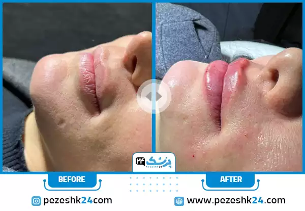 نمونه کار قبل و بعد تزریق ژل لب طبیعی در کلینیک سینایار در اصفهان