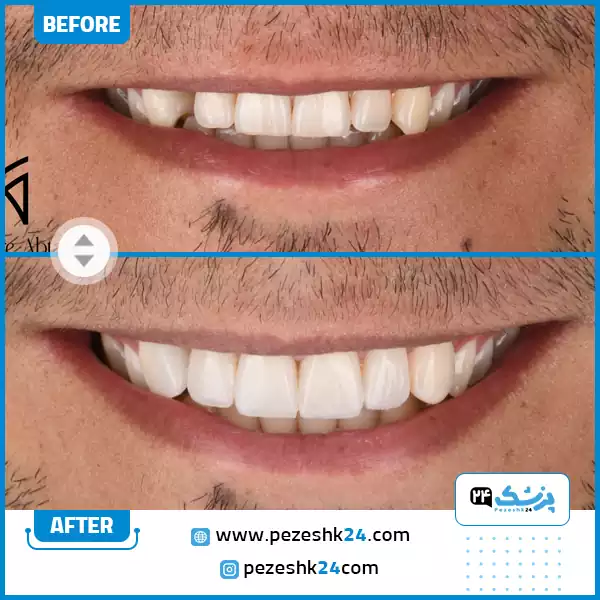 نمونه کار قبل و بعد بهترین دکتر کامپوزیت در اصفهان