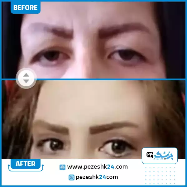 قبل و بعد جراحی بلفاروپلاستی دکتر رزاززاده اصفهان