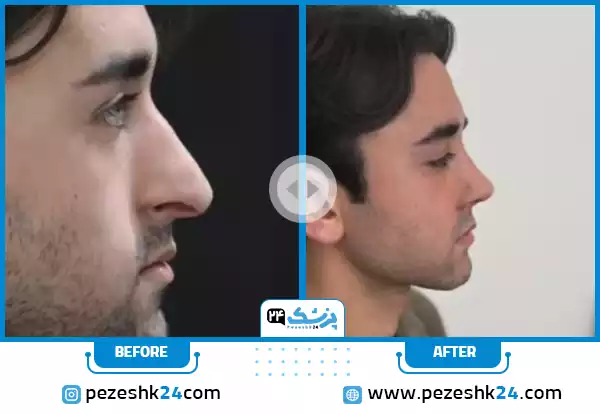 قبل و بعد عمل بینی فانتزی دکتر اسماعیل پور مشهد