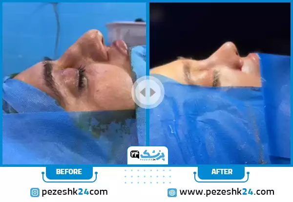 قبل و بعد عمل بینی عروسکی دکتر اسماعیل پور مشهد