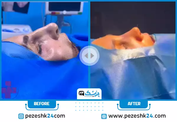قبل و بعد عمل بینی عروسکی دکتر اسماعیل پور