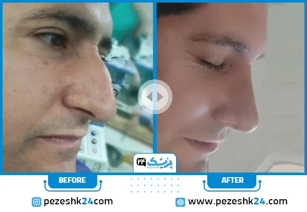نمونه عمل بینی غضروفی دکتر محمدیان شیراز