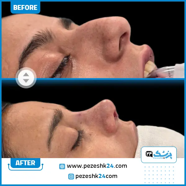 جراحی بینی عروسکی دکتر موسوی