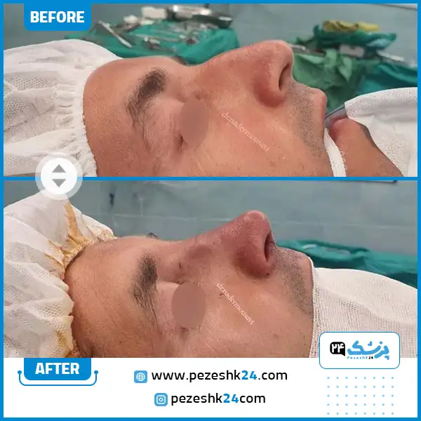 جراحی بینی عروسکی دکتر موسوی در شیراز