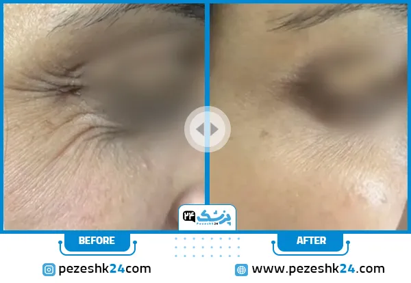 قبل و بعد تزریق بوتاکس دکتر ارگنجی