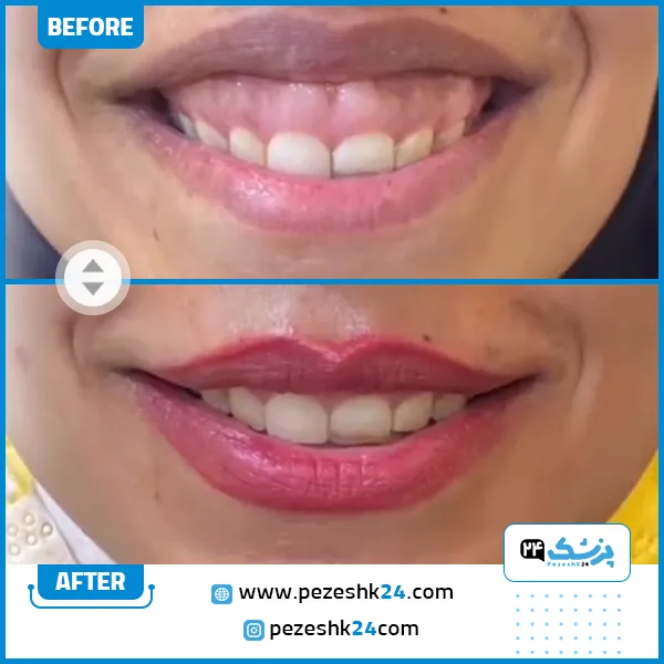 قبل و بعد بوتاکس لبخند لثه ای دکتر ارگنجی مشهد