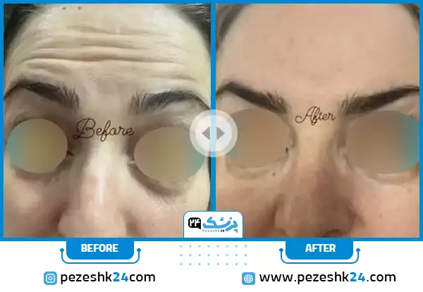 قبل و بعد تزریق بوتاکس دکتر اسمعیل پور