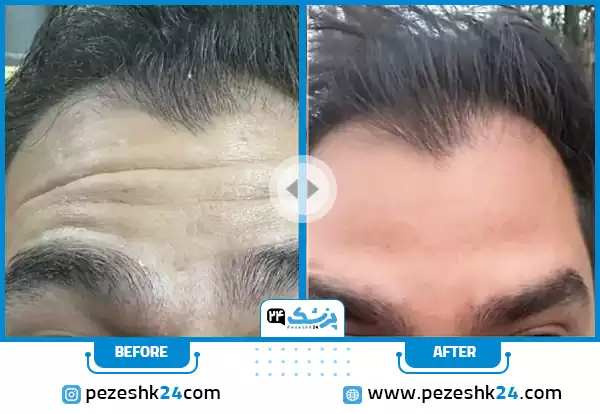 قبل و بعد تزریق بوتاکس دکتر اسمعیل پور اصفهان