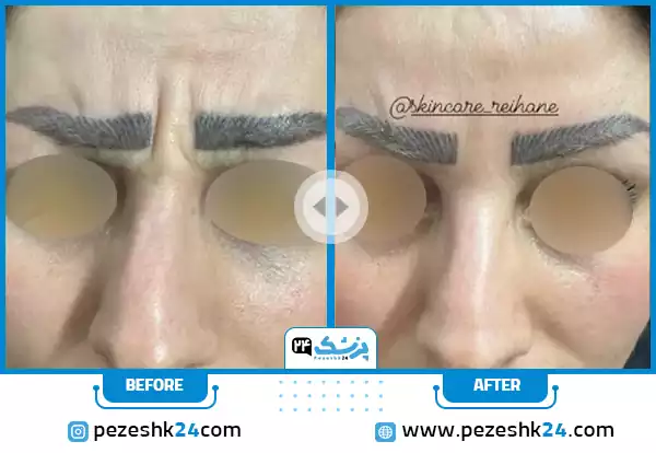 قبل و بعد بوتاکس دکتر نسرین اسمعیل پور اصفهان