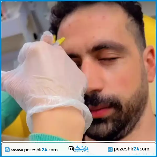 قبل و بعد بوتاکس دکتر نسرین اسمعیل پور