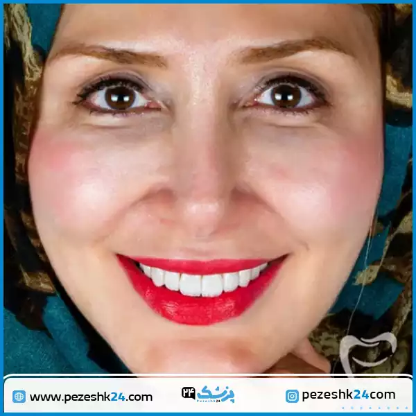 کامپوزیت دندان دکتر کاظمی زاده اصفهان