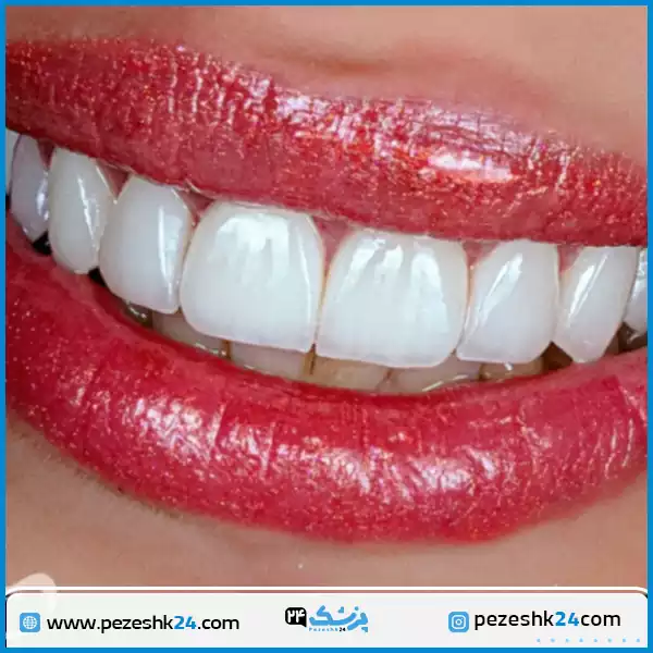 نمونه کار کامپوزیت دکتر کاظمی زاده اصفهان