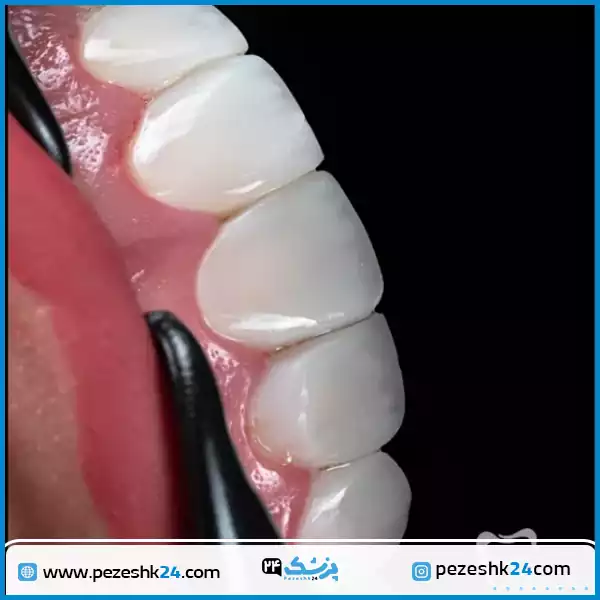 نمونه کار ونیر کامپوزیت دکتر کاظمی زاده اصفهان