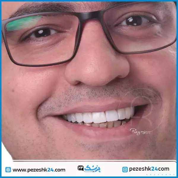 نمونه ونیر کامپوزیت دندان دکتر رزمجو