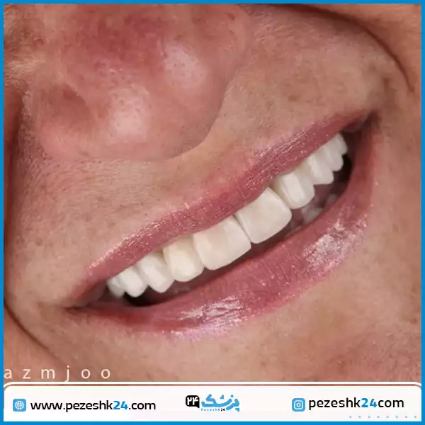 نمونه ونیر کامپوزیت دندان دکتر رزمجو اصفهان