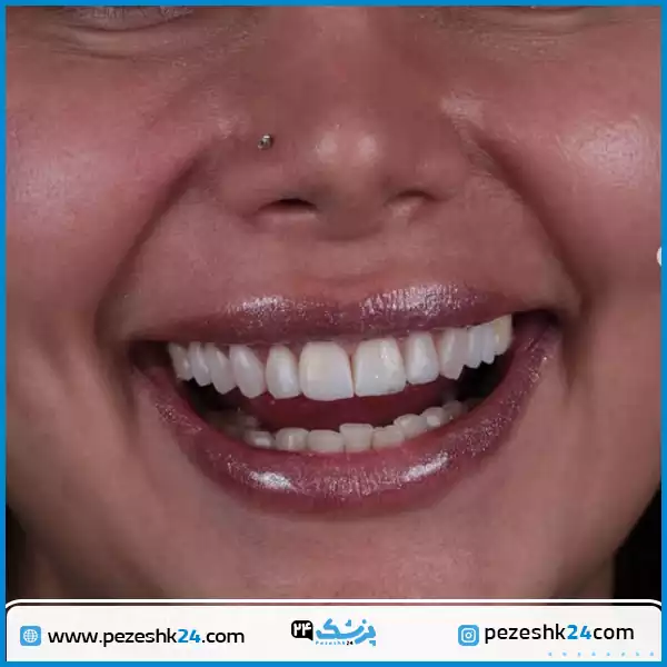 نمونه کامپوزیت دندان دکتر رزمجو اصفهان