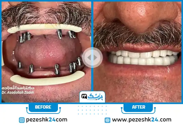قبل و بعد ایمپلنت دندان دکتر اسداله زاده در مشهد