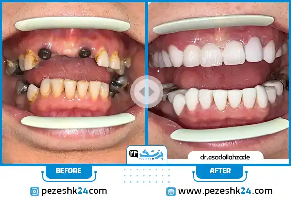 قبل و بعد ایمپلنت دکتر اسداله زاده در مشهد