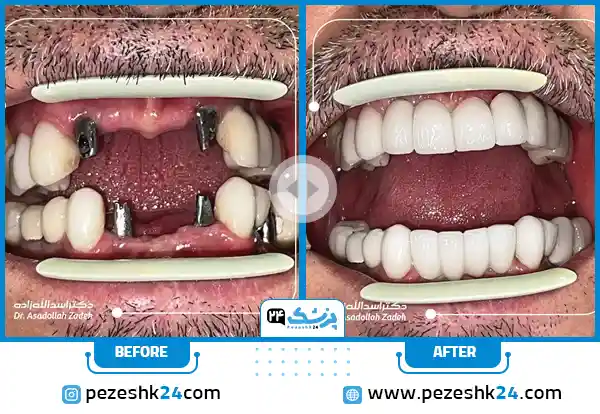 قبل و بعد ایمپلنت دکتر اسداله زاده