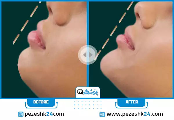 قبل و بعد تزریق فیلر چانه دکتر حشمتی در تهران