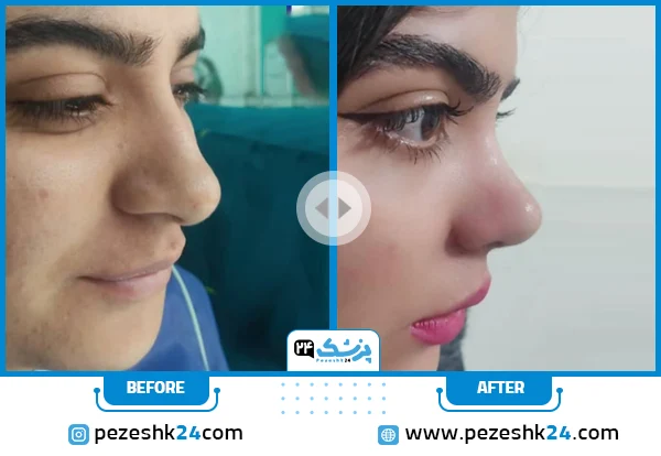 نمونه جراحی بینی گوشتی دکتر محمدیان