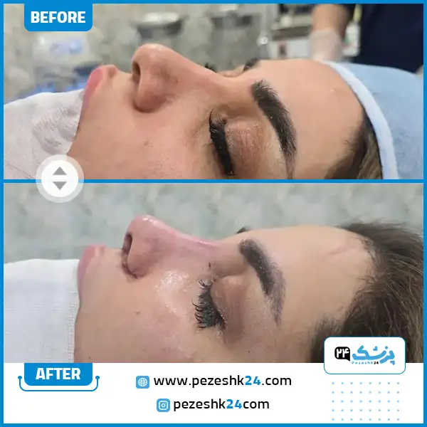 جراحی بینی فانتزی دکتر موسوی در شیراز