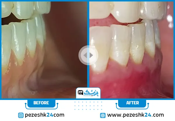 عکسهای لیفت لثه دکتر ضرابی