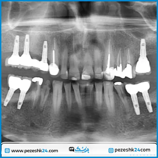 ایمپلنت کل فک بالا و پایین دکتر ضرابی