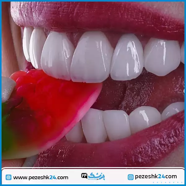 نمونه لمینت دندان دکتر کاظمی زاده