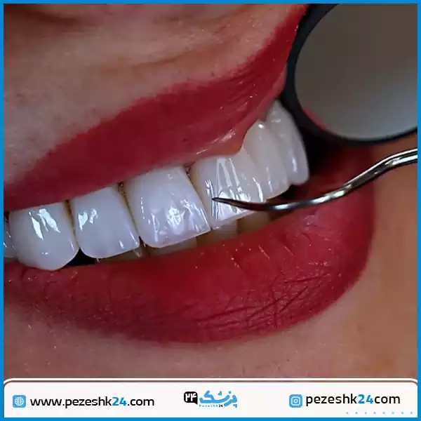 نمونه لمینت دندان دکتر کاظمی زاده اصفهان