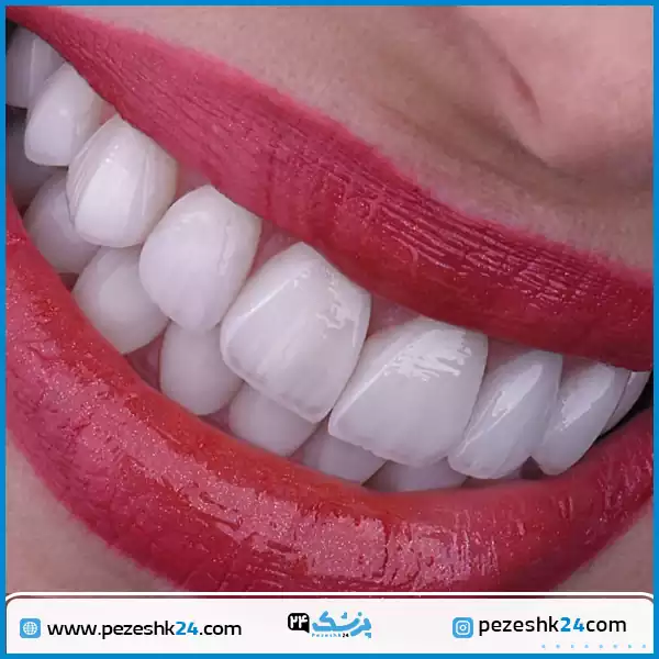 نمونه لمینت سرامیکی دکتر کاظمی زاده اصفهان