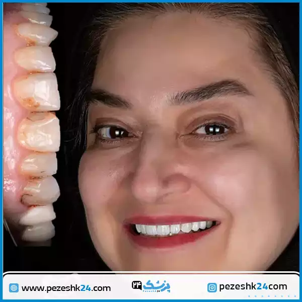 نمونه کار لمینت سرامیکی دکتر کاظمی زاده اصفهان