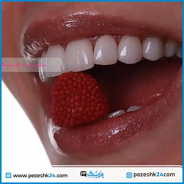 نمونه لمینت دندان دکتر رزمجو اصفهان