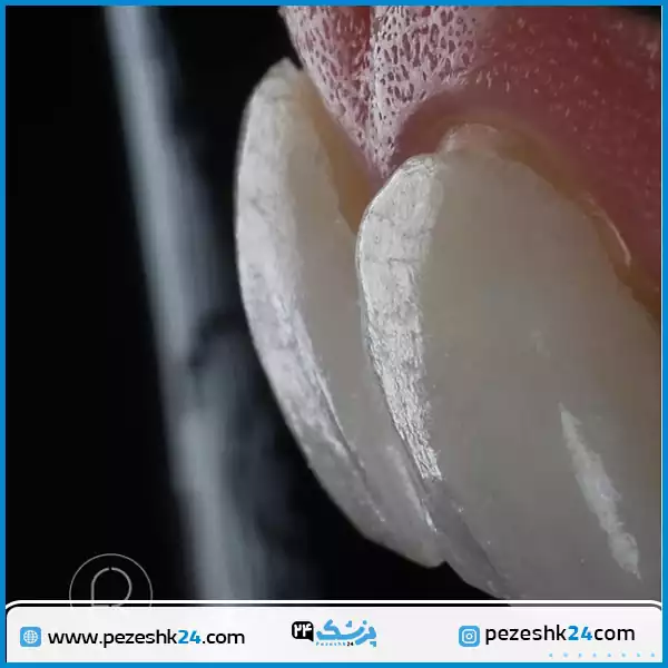 نمونه کار لمینت دندان دکتر رزمجو اصفهان
