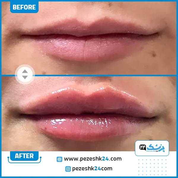 ژل لب دکتر صداقت در مشهد