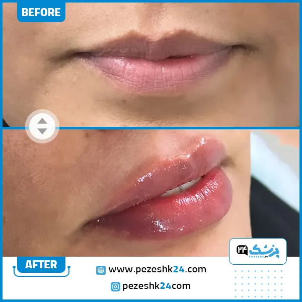 نمونه ژل لب دکتر صداقت در مشهد