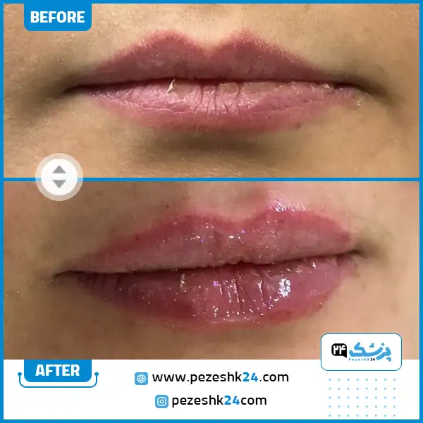 نمونه تزریق ژل لب دکتر صداقت در مشهد