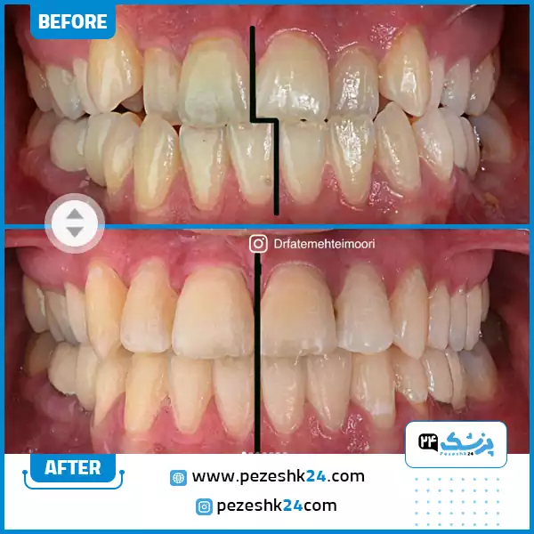 نمونه کار ارتودنسی دکتر تیموری اصفهان