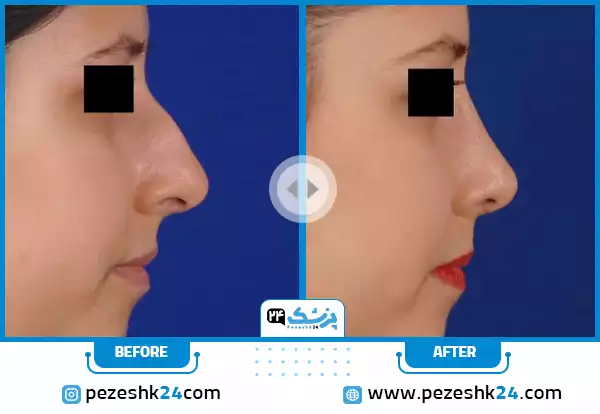 قبل و بعد عمل بینی دکتر آقائی