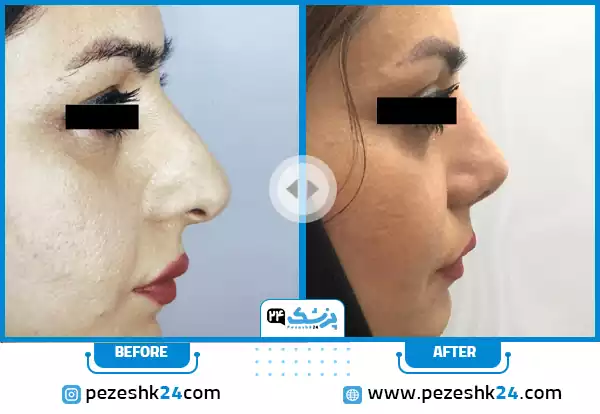 قبل و بعد عمل زیبایی بینی دکتر آقائی مشهد