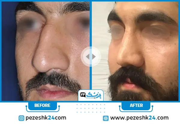 عکس قبل و بعد عمل انحراف بینی دکتر کمندی